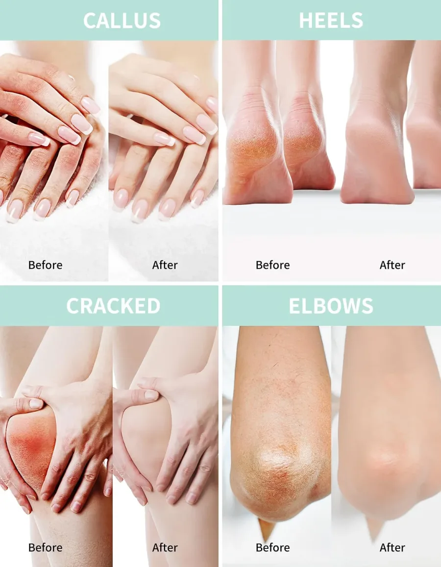 Grocerism urea cream applied to soften dry callused heels